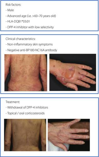 Bullous Pemphigoid With Dipeptidyl Peptidase-4 Inhibitors: Clinical ...