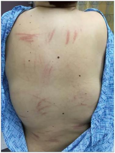 Pruritic Rash In A Woman With Hodgkin Lymphoma Jama Oncology X Mol