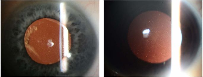 corneal guttata retroillumination