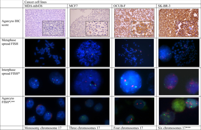 HER2, Chromosome 17 Polysomy And DNA Ploidy Status In Breast Cancer; A ...