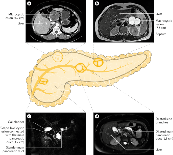 Diagnosis And Management Of Pancreatic Cystic Neoplasms: Current ...