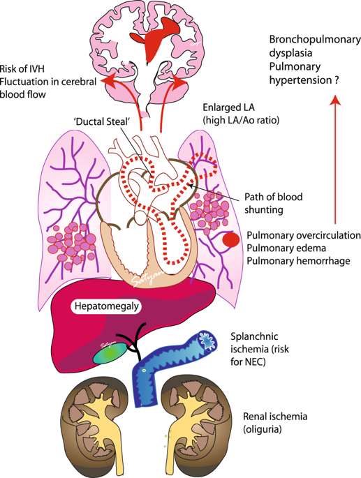 Patent Ductus Arteriosus In Preterm Infants Is Early Transcatheter Closure A Paradigm Shift Journal Of Perinatology X Mol