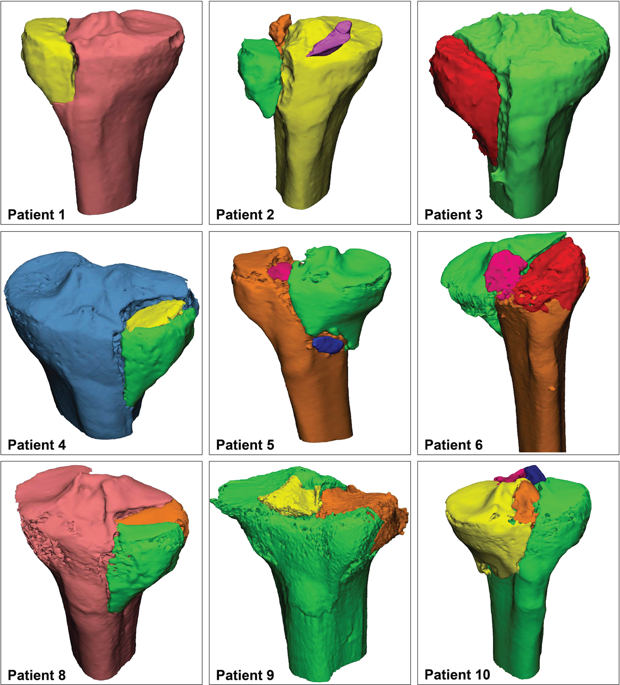 胫骨平台骨折的定量3d测量 Scientific Reports X Mol