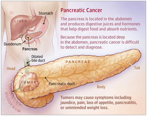 pancreatic-cancer-jama-x-mol