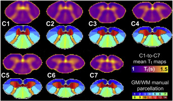 Anterior Fissure Central Canal Posterior Septum And More New Insights Into The Cervical Spinal Cord Gray And White Matter Regional Organization Using T1 Mapping At 7t Neuroimage X Mol