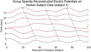 Bayesian Inverse Methods For Spatiotemporal Characterization Of Gastric Electrical Activity From Cutaneous Multi Electrode Recordings Plos One X Mol