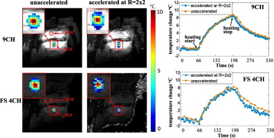 A Flexible 9 Channel Coil Array For Fast 3d Mr Thermometry In Mr Guided High Intensity Focused Ultrasound Hifu Studies On Rabbits At 3 T Magnetic Resonance Imaging X Mol