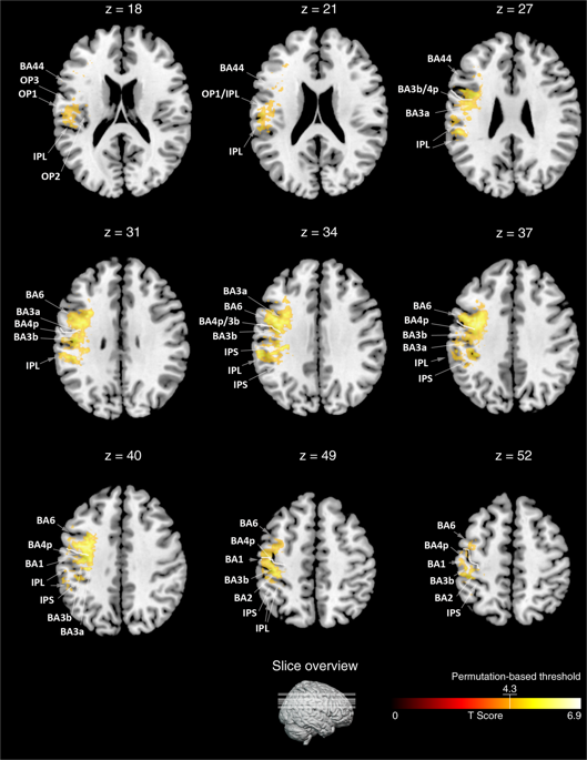 Prefrontal And Posterior Parietal Contributions To The Perceptual Awareness Of Touch Scientific Reports X Mol