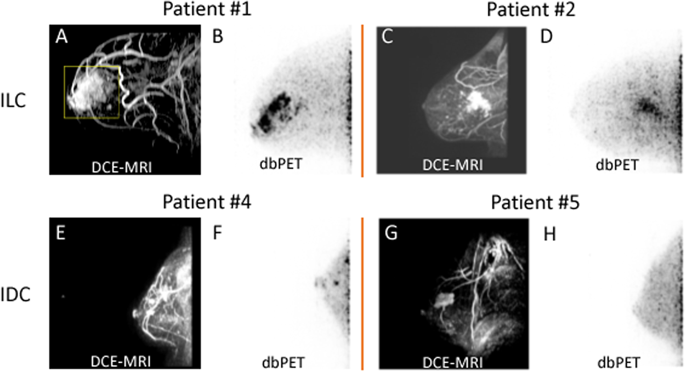 Initial Experience Of Dedicated Breast PET Imaging Of ER+ Breast ...