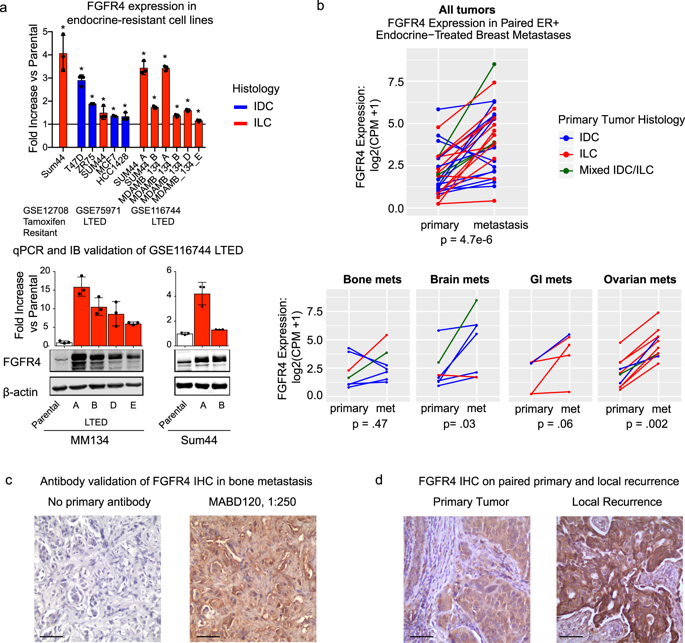 FGFR4 Overexpression And Hotspot Mutations In Metastatic ER+ Breast ...