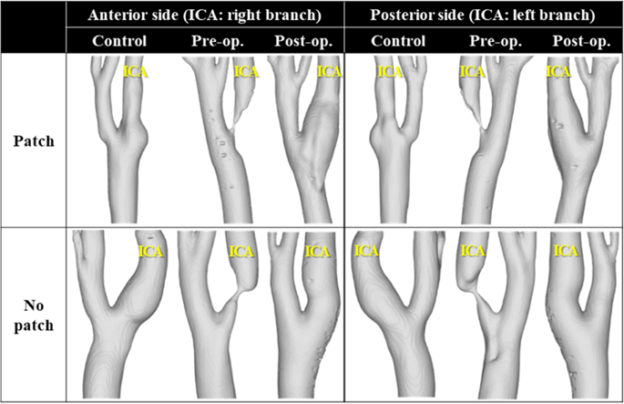 Patient Specific Hemodynamics Of Severe Carotid Artery Stenosis Before And After Endarterectomy Examined By 4d Flow Mri Scientific Reports X Mol