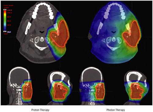 Comparative Effectiveness Of Proton Vs Photon Therapy As Part Of Concurrent Chemoradiotherapy For Locally Advanced Cancer Jama Oncology X Mol