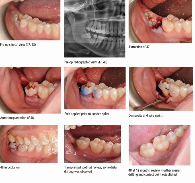 Autotransplantation Of Third Molars A Literature Review And