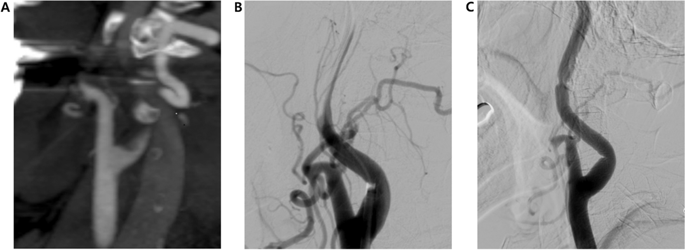 Pseudo Occlusion Of The Internal Carotid Artery In Acute Ischemic Stroke Clinical Outcome After 2132