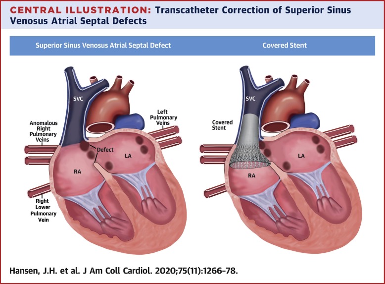 transcatheter-correction-of-superior-sinus-venosus-atrial-septal