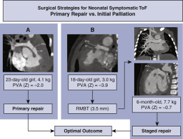 Surgical Treatment Of Tetralogy Of Fallot In Symptomatic Neonates And Young Infants The Journal Of Thoracic And Cardiovascular Surgery X Mol