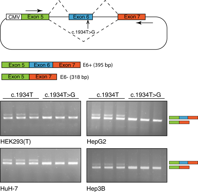 Atp7b Variant C 1934t G P Met645arg Causes Wilson Disease By Promoting Exon 6 Skipping Npj Genomic Medicine X Mol