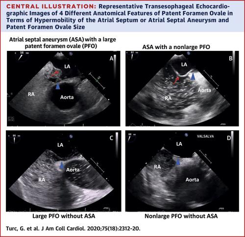 Atrial Septal Aneurysm Shunt Size And Recurrent Stroke Risk In Patients With Patent Foramen Ovale Journal Of The American College Of Cardiology X Mol