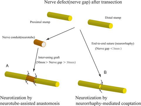 Efficacy Evaluation Of Personalized Coaptation In Neurotization For Motor Deficit After Peripheral Nerve Injury A Systematic Review And Meta Analysis Brain And Behavior X Mol