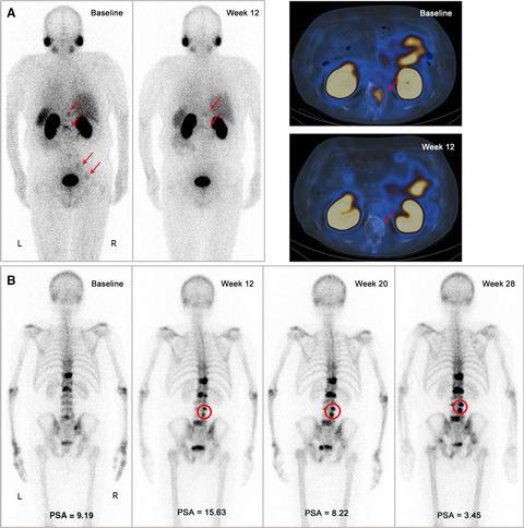 Preliminary Results Of Targeted Prostate Specific Membrane Antigen Imaging In Evaluating The Efficacy Of A Novel Hormone Agent In Metastatic Castration Resistant Prostate Cancer Cancer Medicine X Mol