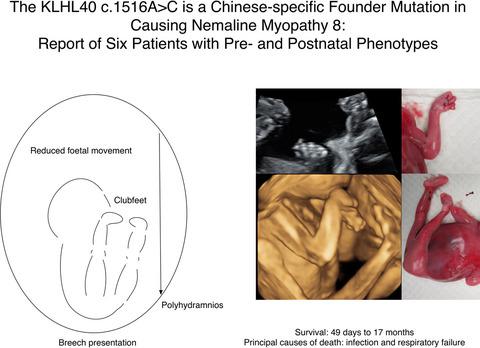 The Klhl40 C 1516a C Is A Chinese Specific Founder Mutation Causing Nemaline Myopathy 8 Report Of Six Patients With Pre And Postnatal Phenotypes Molecular Genetics Genomic Medicine X Mol