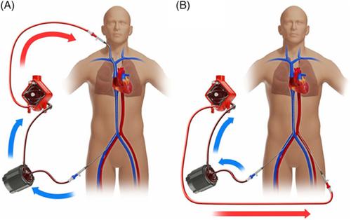 Optimization Of Extracorporeal Membrane Oxygenation Therapy Using Near Infrared Spectroscopy To Assess Changes In Peripheral Circulation A Pilot Study Journal Of Biophotonics X Mol
