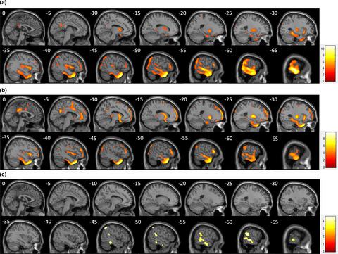 在颞叶内侧癫痫发作中的头顶网络 Brain And Behavior X Mol