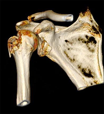 Injury Mechanism of Acute Anterior Shoulder Dislocation Associated 