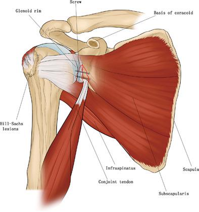 Treatment of Chronic Anterior Shoulder Dislocation by Coracoid ...