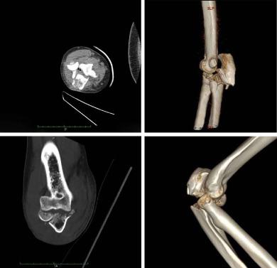 成人近端尺骨后部骨折脱位与孟氏后骨折的区别。,Orthopaedic Surgery 