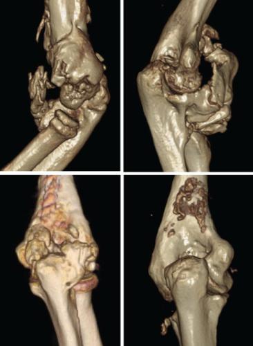 Heterotopic Ossification after Arthroscopic Elbow Release 