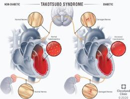 Takotsubo Syndrome Does Diabetes Paradox Exist Heart Lung X Mol