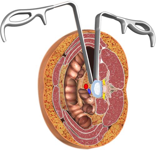 Anteroinferior Psoas Technique for Oblique Lateral Lumbar 