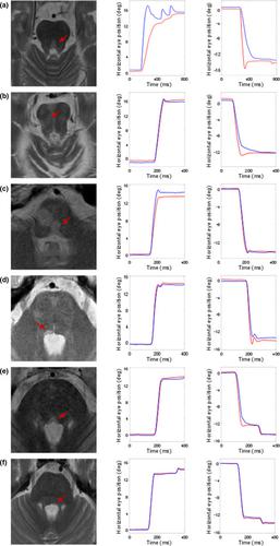 询问多发性硬化的临床放射学悖论的模型 核间眼肌麻痹 European Journal Of Neurology X Mol