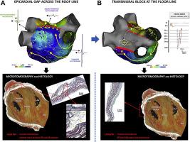 Epicardial Course Of The Septopulmonary Bundle Anatomical Considerations And Clinical Implications For Roof Line Completion Heart Rhythm X Mol