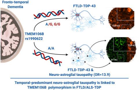 一种与ftld Als Tdp 中tmem106b 基因多态性相关的新型时间主导神经星形胶质细胞tau 蛋白病变 Brain Pathology X Mol