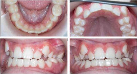 Wiedemann-Steiner综合征：一例报告,Clinical Case Reports - X-MOL