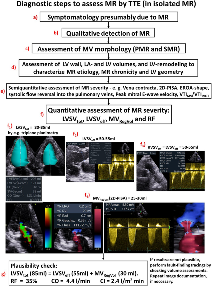 Echocardiographic Assessment Of Mitral Regurgitation Discussion Of Practical And Methodologic Aspects Of Severity Quantification To Improve Diagnostic Conclusiveness Clinical Research In Cardiology X Mol
