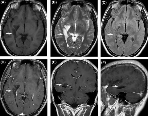 Intraventricular Dysembryoplastic Neuroepithelial Tumor In The Temporal Horn With Broad Involvement Of The Ependyma Clinical Case Reports X Mol