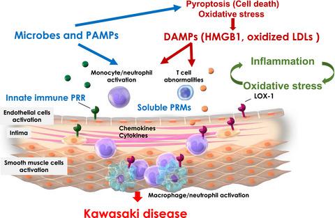 川崎病的最新病理生理,Clinical & Translational Immunology - X-MOL