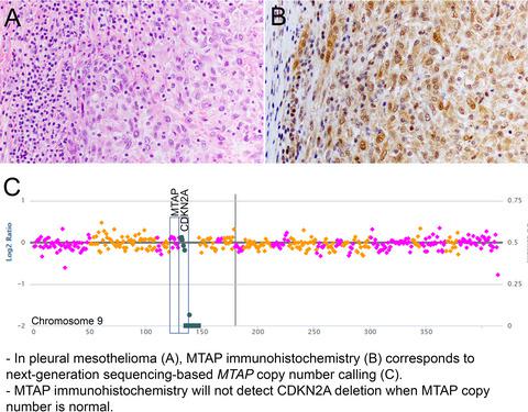 Correlation Of Methylthioadenosine Phosphorylase Mtap Protein Expression With Mtap And Cdkn2a Copy Number In Malignant Pleural Mesothelioma Histopathology X Mol