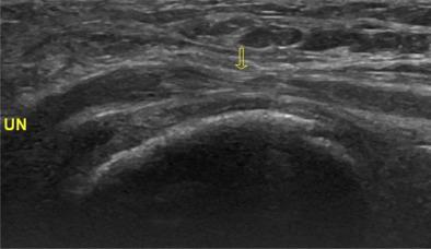 Ultrasound Assisted Precise In Situ Decompression For Cubital Tunnel Syndrome Orthopaedic Surgery X Mol