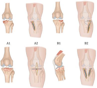 过度伸展膝关节损伤中胫骨平台前部骨折的手术策略 Orthopaedic Surgery X Mol