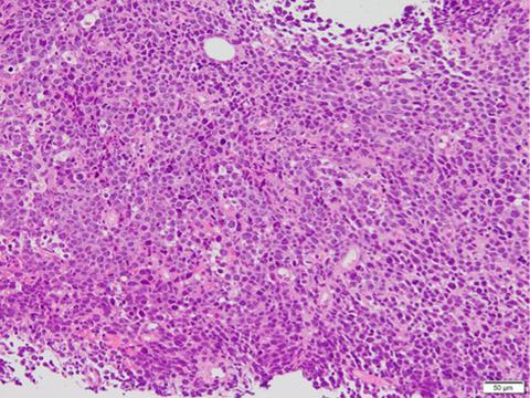 Primary Breast Lymphoma Initially Diagnosed As Invasive Ductal Carcinoma A Case Report Clinical Case Reports X Mol