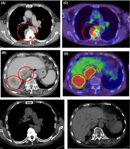 Methotrexate-associated lymphoproliferative disorder with an osteolytic ...