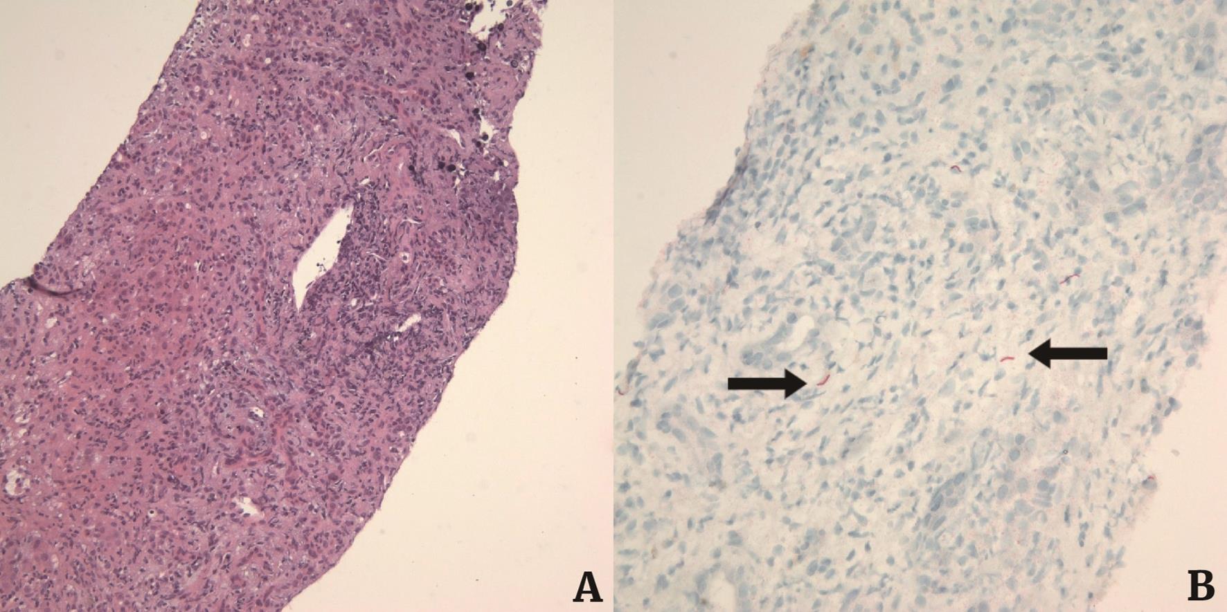 a systematic literature review of syphilitic hepatitis in adults