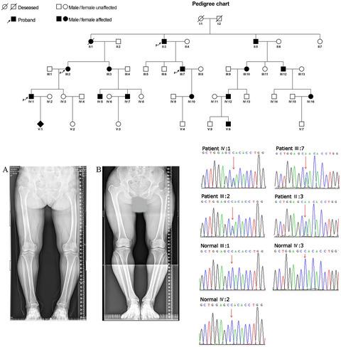 Identification Of A Novel Col10a1 C 1952 G T Variant In A Family With Schmid Metaphyseal Chondrodysplasia And Development Of A Noninvasive Prenatal Testing Method Molecular Genetics Genomic Medicine X Mol