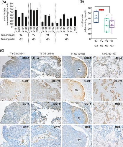 Warburg 效应作为膀胱癌的治疗靶标和相关分子靶标的肿瘤内异质性 Cancer Science X Mol