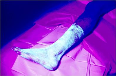 我们应该准备脚吗 髋关节置换术中丝袜的使用和悬垂污染 一项实验研究 Anz Journal Of Surgery X Mol