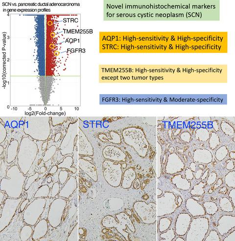 免疫组织化学分析用于诊断胰腺浆液性肿瘤的新见解 水通道蛋白1 立体纤毛蛋白和跨膜蛋白255b Histopathology X Mol